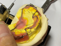 Appareil d'orthodontie sur mesure avec une bonne rétention et des caractéristiques réglables