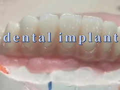 Crowns et ponts en titane pour les implants dentaires pour la restauration et le remplacement des dents