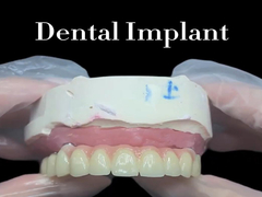 Les implants dentaires sont la solution idéale pour remplacer les dents manquantes et restaurer votre sourire.