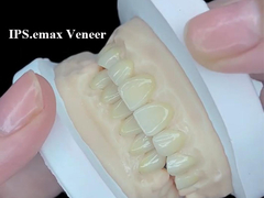 IPS.emax Veneer est une solution esthétique haut de gamme pour des transformations de sourires étonnantes