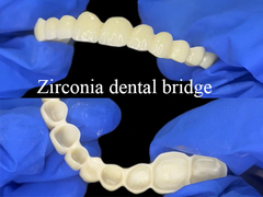 Le pont dentaire en zirconium est une restauration d'aspect naturel et solide pour un sourire parfait