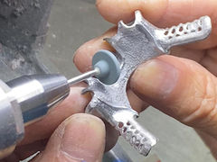 Prothèse partielle coulée