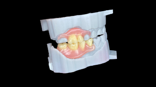 Prothèses flexibles personnalisées avec un ajustement naturel et un confort durable.