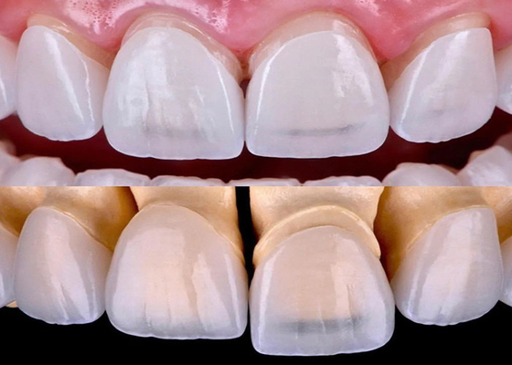 acheter Veneur dentaire EMAX à longue durée de vie fabriqué à partir d'un matériau en zirconium céramique online manufacture