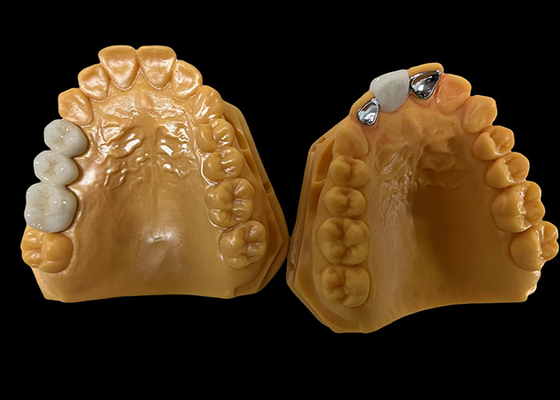 acheter Porcelaine à translucide modéré fondue dans le métal couronne PFM, couronne céramique PFM online manufacture