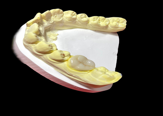 acheter Des incrustations et des incrustations en céramique de haute qualité pour la restauration des dents sans couture et durable online manufacture