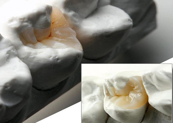 acheter Des incrustations et des onlays en céramique naturelles pour une restauration dentaire précise de notre laboratoire dentaire expert online manufacture