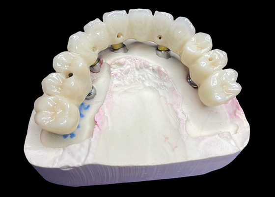 acheter Des couronnes et des ponts d'implants dentaires à arc complet restaurent la fonction et l'esthétique avec des solutions avancées online manufacture