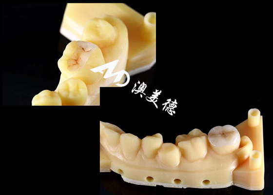 acheter Inlays et onlays en céramique de précision pour la réparation des dents avec des couleurs naturelles, un matériau hypoallergénique et un ajustement sans couture pour un confort et une durabilité supérieurs online manufacture