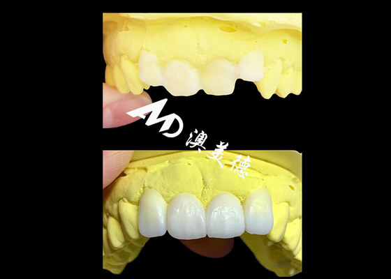 acheter Des couronnes dentaires en zirconium translucides sur mesure fabriquées par AMD Dental Lab online manufacture