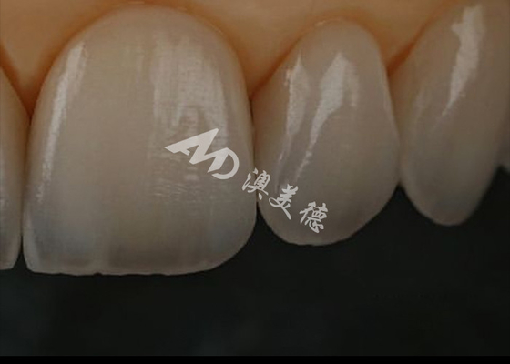 acheter Résistance aux éclats couronne dentaire en zirconium pour les dents antérieures / postérieures online manufacture