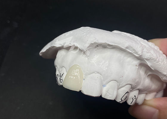 Bon prix Les facettes dentaires translucides sont des solutions rapides et efficaces pour un sourire durable en ligne