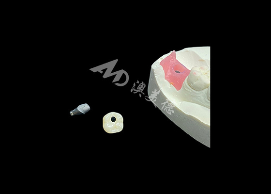 acheter Des couronnes d'implants dentaires à longue durée de vie révolutionnent les procédures de restauration dentaire online manufacture