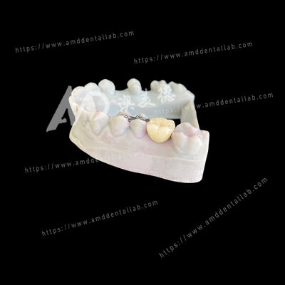 acheter PFM Maryland Bridge One Pontic Two Wings Une solution conservatrice et esthétique online manufacture