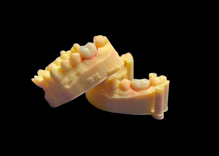 Une couronne dentaire en porcelaine en zirconium de qualité supérieure résistance inégalée précision de l'ajustement et esthétique et durabilité exceptionnelles