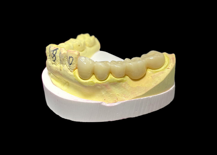 Une couronne dentaire en porcelaine en zirconium de qualité supérieure résistance inégalée précision de l'ajustement et esthétique et durabilité exceptionnelles