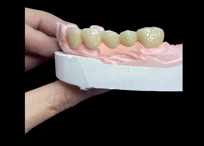 Toutes les couronnes et ponts en céramique sont conçus pour une esthétique supérieure, une durabilité et une adéquation naturelle pour une confiance durable.
