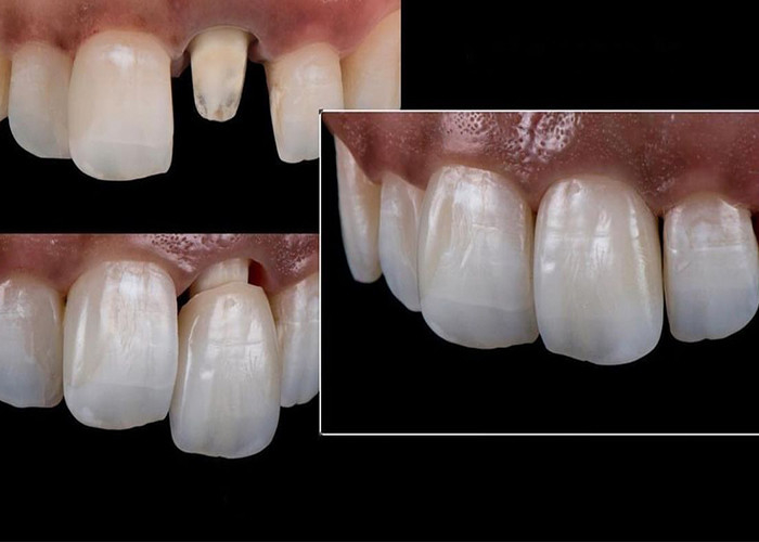 Toutes les couronnes et ponts en céramique sont conçus pour une esthétique supérieure, une durabilité et une adéquation naturelle pour une confiance durable.
