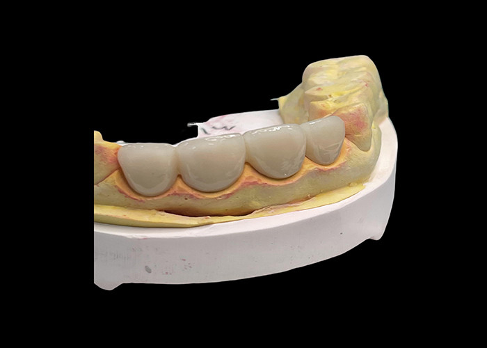 Durable résistant à l'usure Résistance à l'usure Tout le pont de couronne en céramique avec une excellente biocompatibilité pour la restauration dentaire