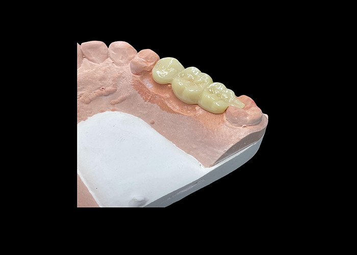 Esthétique naturelle Couronnes en céramique translucide pour la restauration dentaire avec un nettoyage facile et des résultats durables