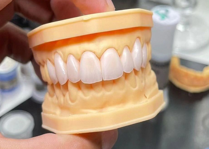 Pont à couronne en céramique de haute résistance avec une biocompatibilité exceptionnelle pour une durabilité durable