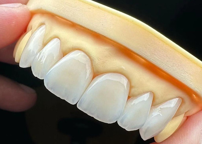 Pont à couronne en céramique de haute résistance avec une biocompatibilité exceptionnelle pour une durabilité durable