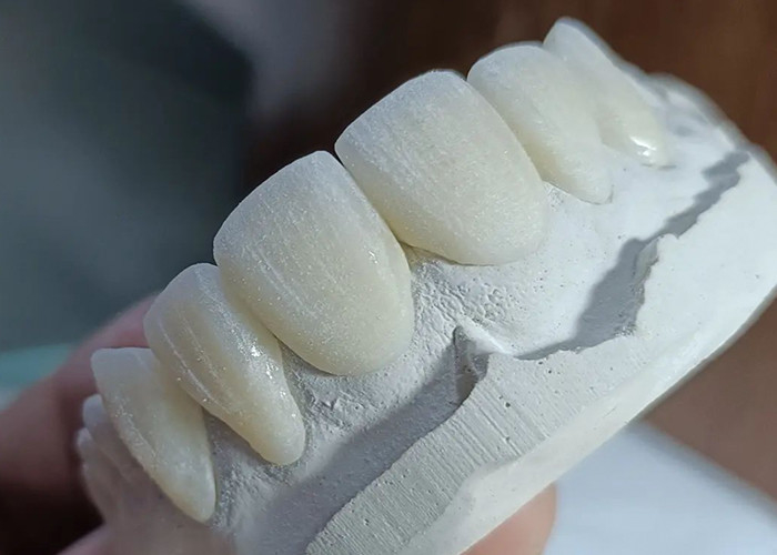 Puits de couronne en céramique résistant à l'usure pour une restauration dentaire confortable et précise