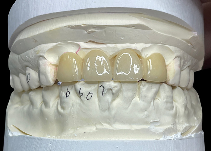 Résistant aux taches Tout pont en porcelaine Confortable Adapté à la restauration dentaire