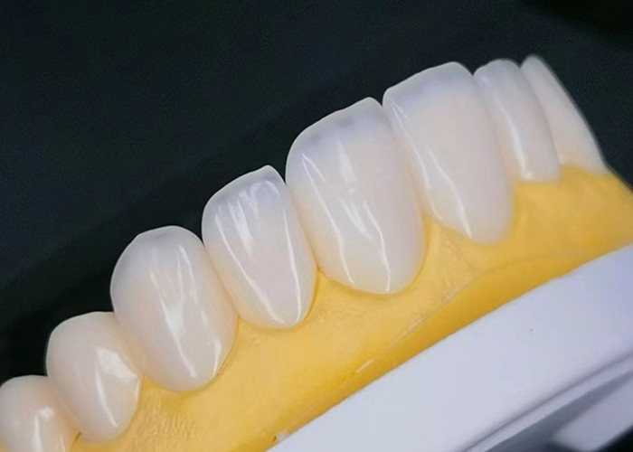 Veneer de porcelaine EMAX avec résistance aux taches pour des restaurations esthétiques naturelles