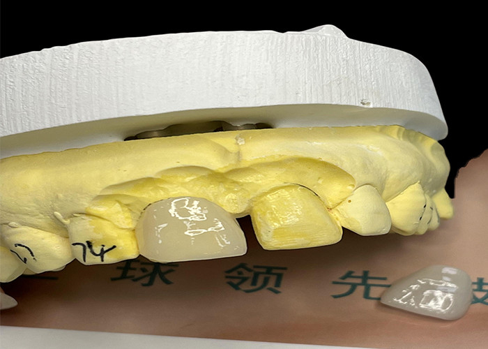 Veneer de porcelaine EMAX avec résistance aux taches pour des restaurations esthétiques naturelles