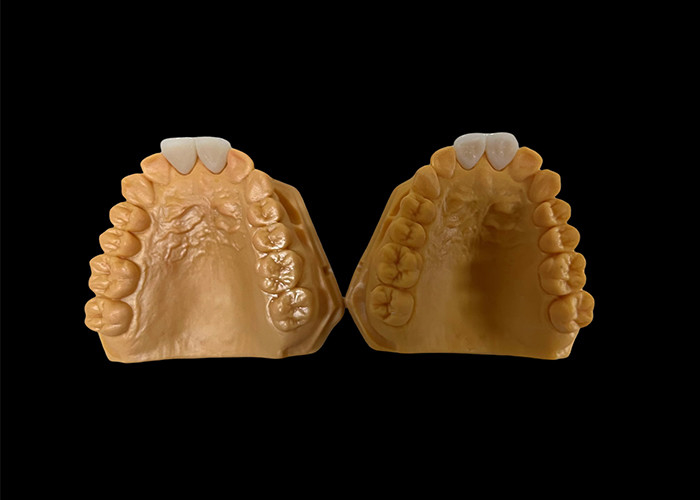 Couronne dentaire en zirconium esthétique personnalisée parfaitement adaptée aux dents antérieures et postérieures