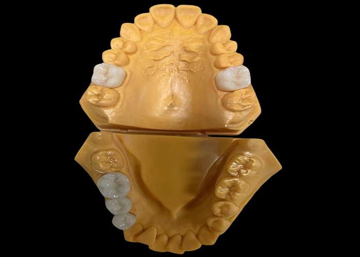 Couronne dentaire en zirconium esthétique personnalisée parfaitement adaptée aux dents antérieures et postérieures