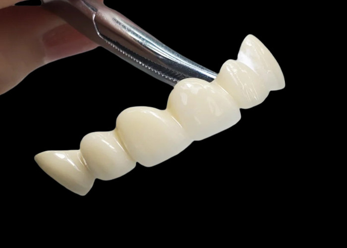 Une couronne dentaire en zirconium translucide sur mesure, résistante aux taches, provenant du laboratoire dentaire chinois.