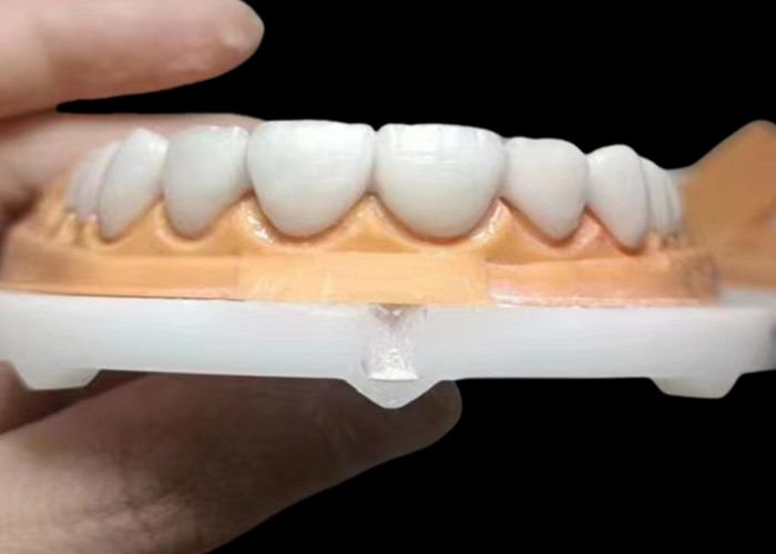 Une couronne dentaire en zirconium translucide sur mesure, résistante aux taches, provenant du laboratoire dentaire chinois.