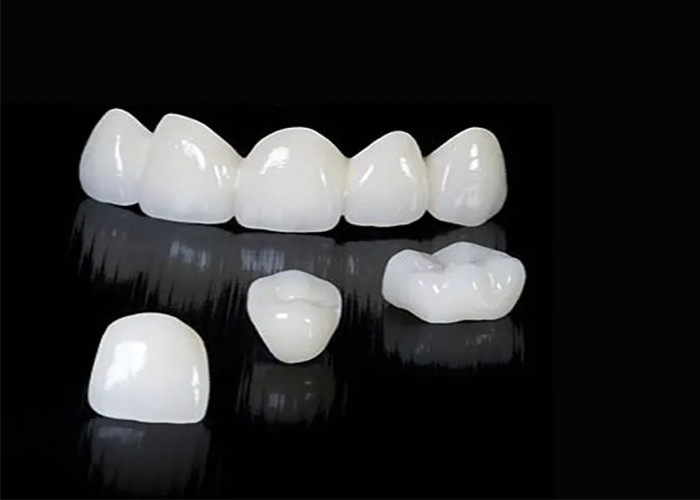 Une couronne dentaire en zirconium translucide sur mesure, résistante aux taches, provenant du laboratoire dentaire chinois.