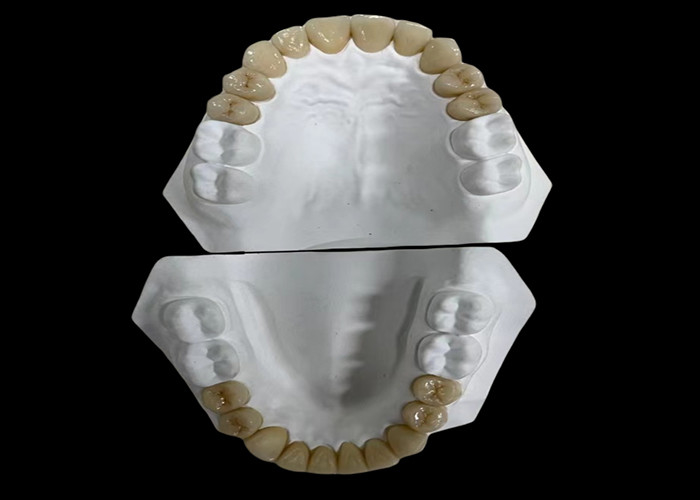 Pont dentaire en porcelaine confortable avec une construction entièrement en céramique pour une résistance à l'usure exceptionnelle