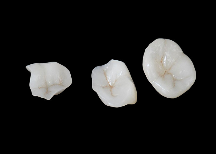 Les incrustations et les incrustations en céramique biocompatibles conçues pour une durabilité confortable et une intégration transparente avec les dents naturelles