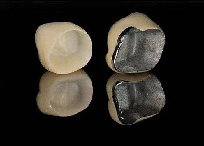 Porcelaine naturelle fondue à une couronne métallique pour restaurer les dents endommagées