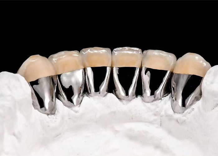 Porcelaine naturelle fondue à une couronne métallique pour restaurer les dents endommagées