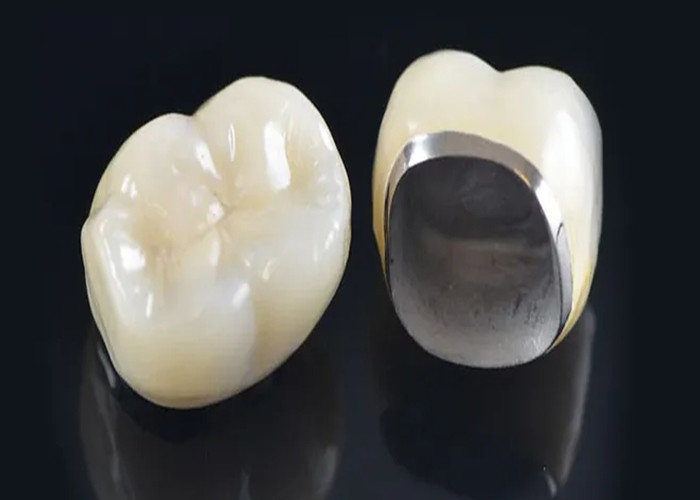 Porcelaine naturelle fondue à une couronne métallique pour restaurer les dents endommagées