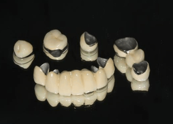 Porcelaine fondue dans le métal PFM Couronne Dentistique résistante à l'usure pour la dentisterie restauratrice
