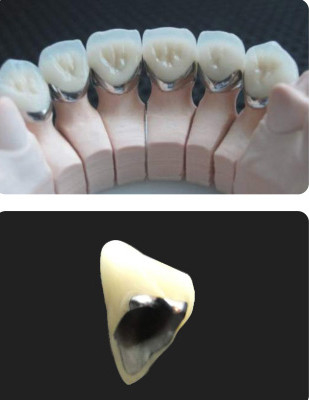 Porcelaine fondue dans le métal PFM Couronne Dentistique résistante à l'usure pour la dentisterie restauratrice