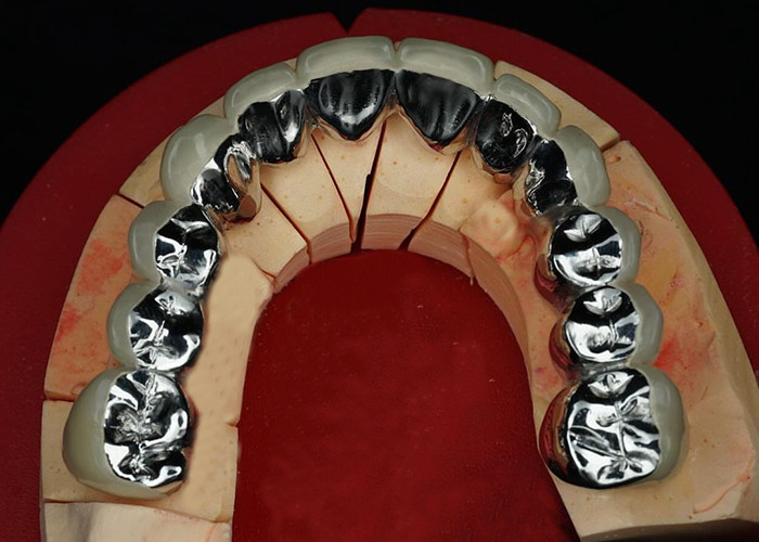 Porcelaine de restauration très durable fusionnée à une couronne métallique pour un sourire naturel