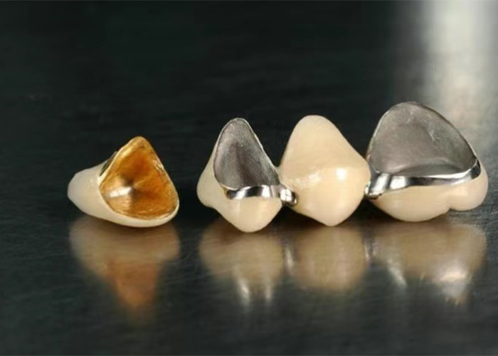 Porcelaine de restauration très durable fusionnée à une couronne métallique pour un sourire naturel