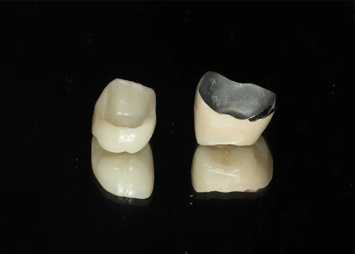 Porcelaine de restauration très durable fusionnée à une couronne métallique pour un sourire naturel