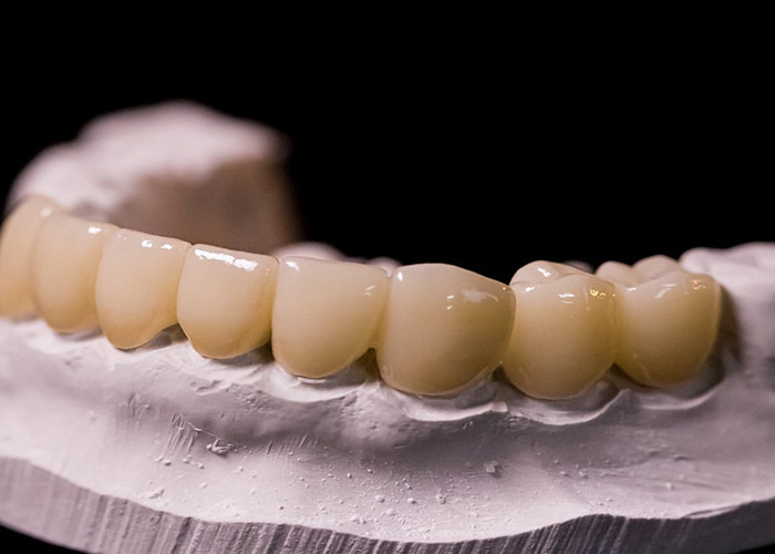 Porcelaine fondue dans des couronnes métalliques: une technologie de pointe pour restaurer un sourire durable