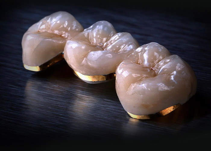Porcelaine fondue dans des couronnes métalliques: une technologie de pointe pour restaurer un sourire durable