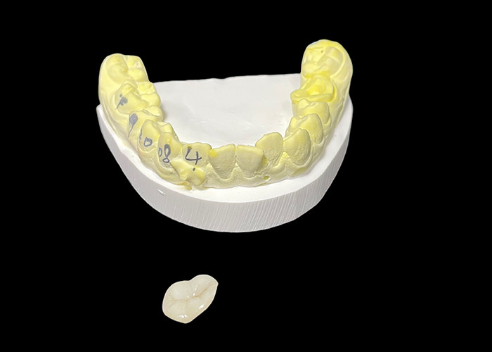 Inlay et onlay en céramique dentaire sur mesure pour les solutions de restauration et la réparation des dents endommagées