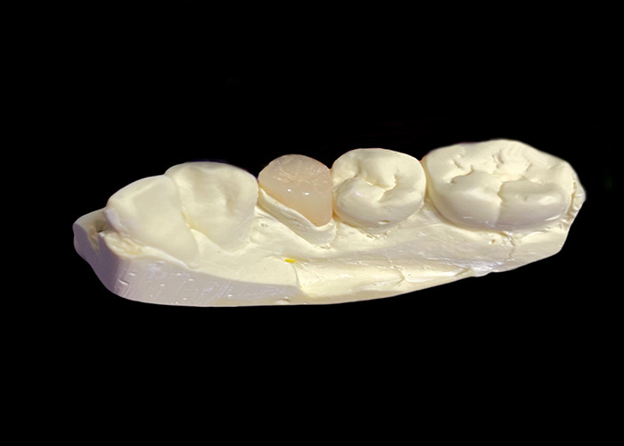 Inlay et onlay en céramique dentaire sur mesure pour les solutions de restauration et la réparation des dents endommagées