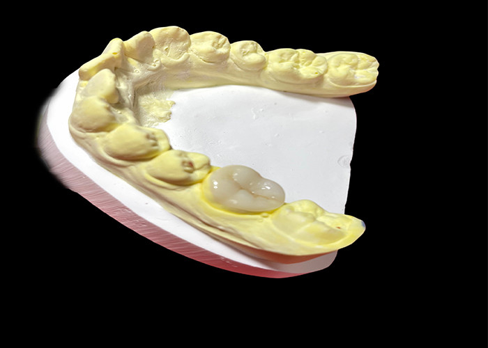 Des incrustations et des incrustations en céramique de haute qualité pour la restauration des dents sans couture et durable
